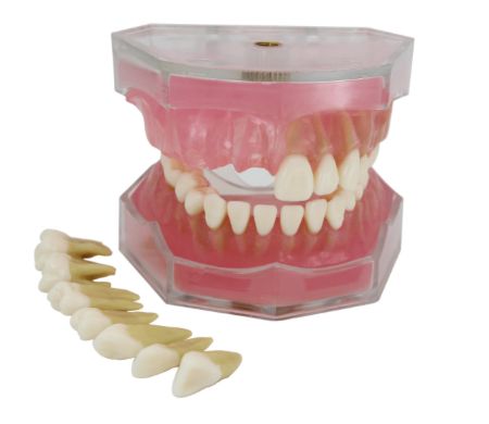 Dental Implant Model